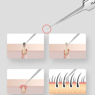 ملقط ألماني فائق الدقة رقم 5 لإزالة الرؤوس السوداء وحب الشباب، أداة خاصة لصالونات التجميل، أداة إبرة لعلاج حب الشباب